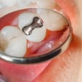 What Types of Fillings Do Dentists Use in the UK?