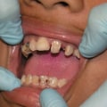 Which Country Has the Best Dental Care?