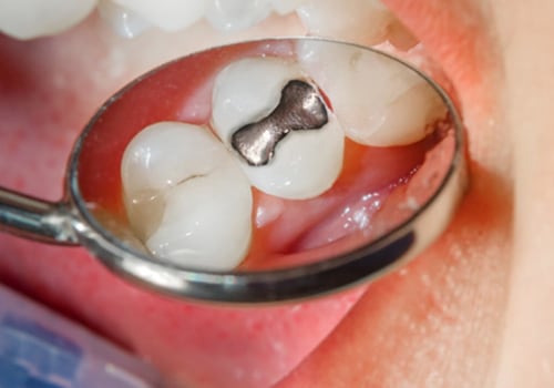 What Types of Fillings Do Dentists Use in the UK?