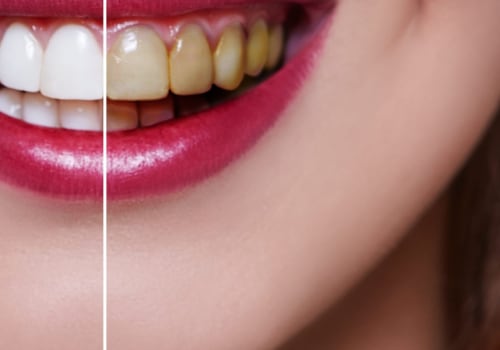 How Much Does it Cost to Get Veneers Fitted at a UK Dentist?